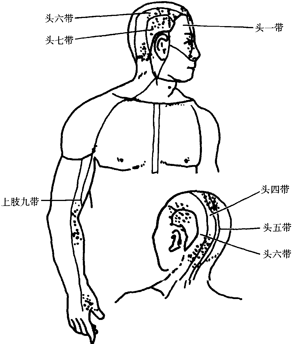 一、頭痛